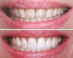 Crown Lengthening Before & After