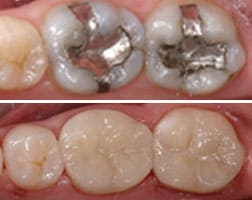 Dental Restoration Before and After Photo