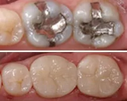 Dental Restoration Before and After Photo